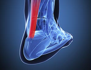 Achilles Tendonitis