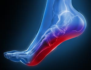 Plantar Fasciitis Pain